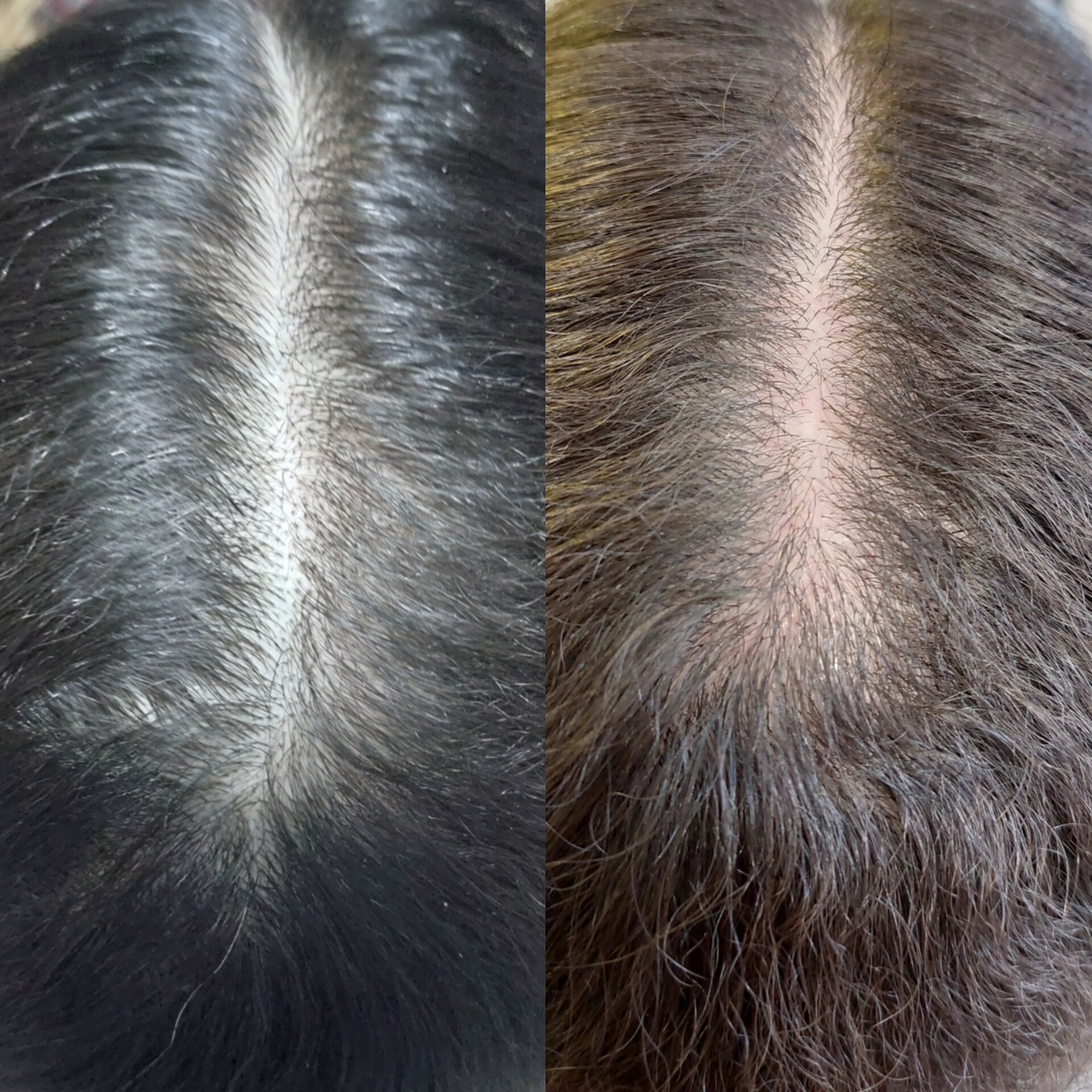 اسکالپ تراپی تخصصی ساری