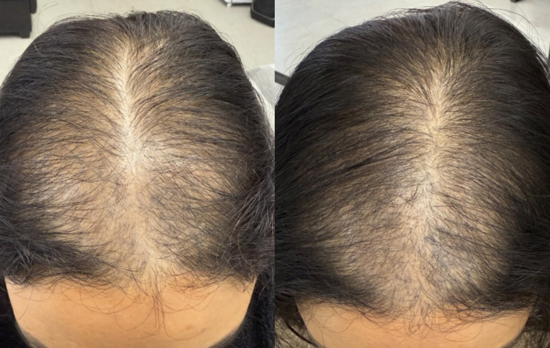 اسکراب کف سر ساری