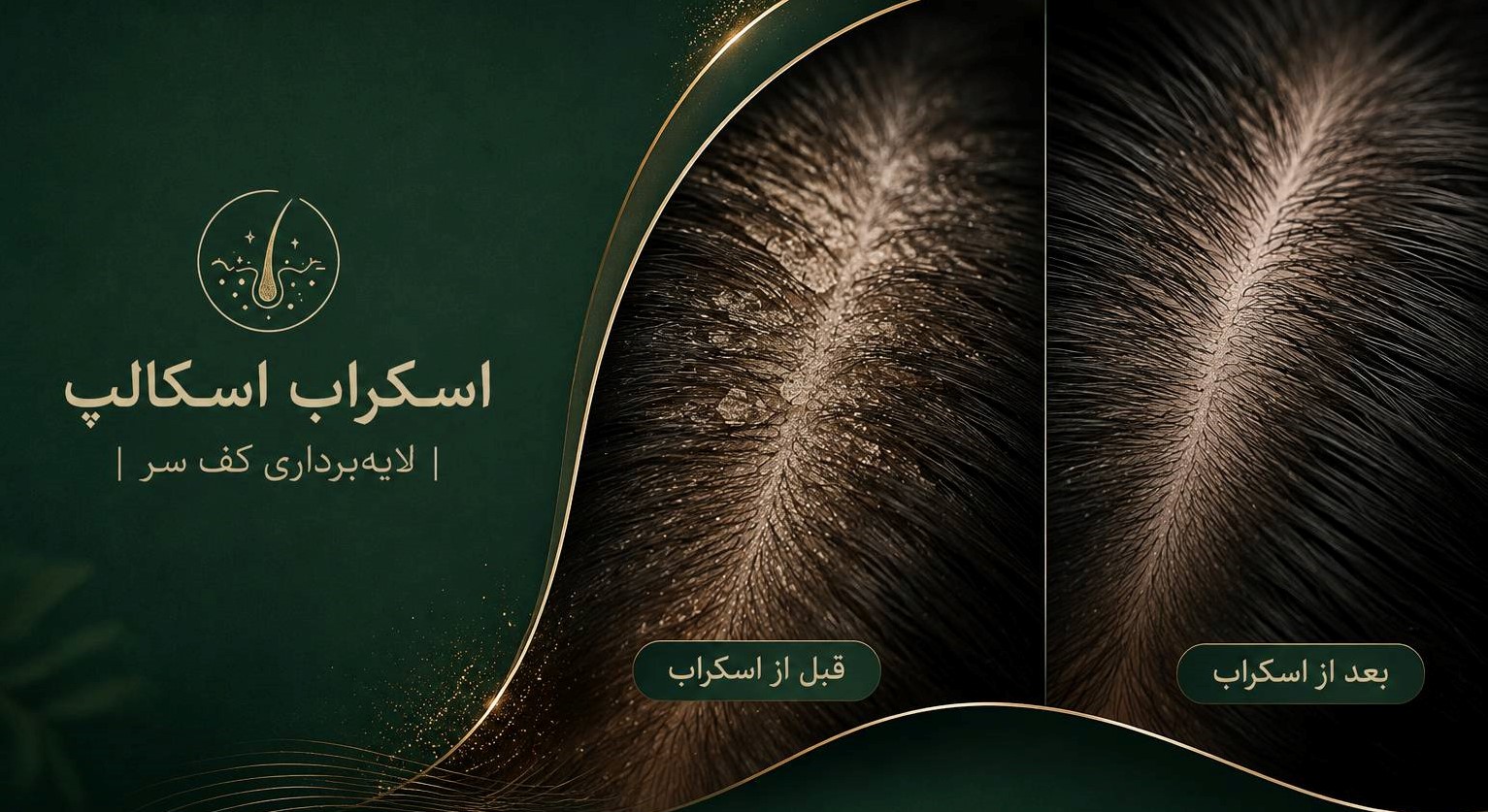 اسکراب اسکالپ و لایهبرداری کف سر