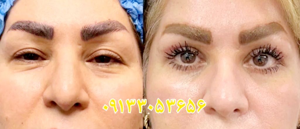 دکتربابایی متخصص عمل بینی گوشتی در اصفهان