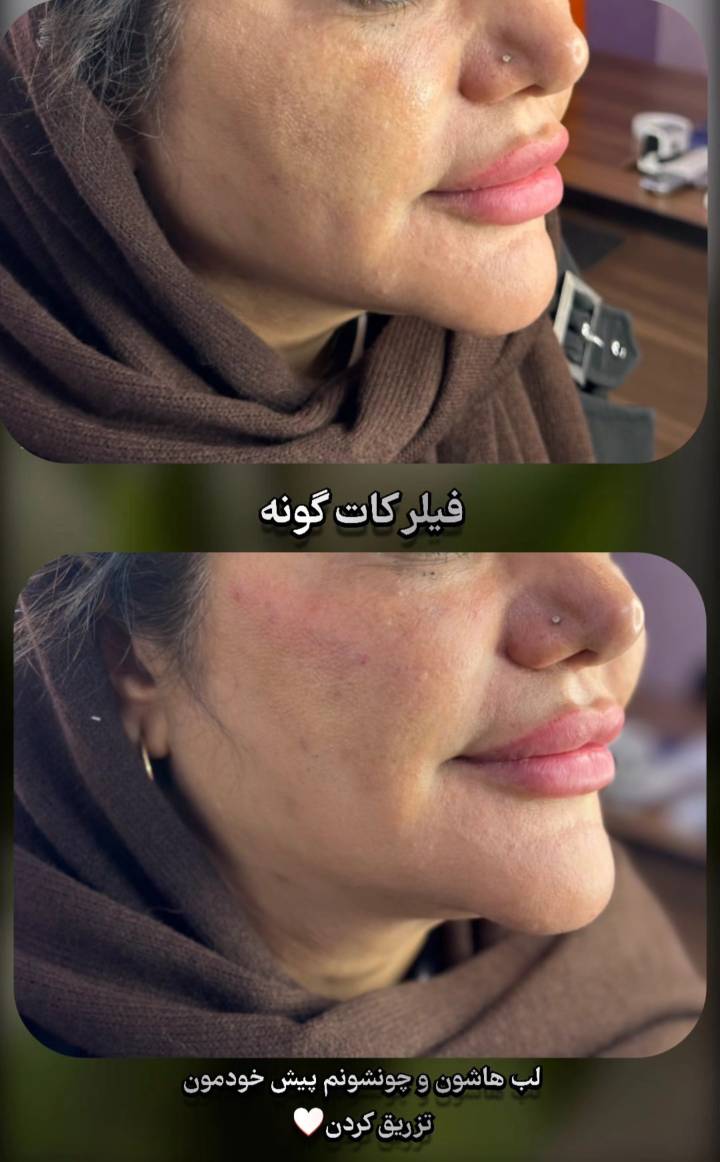 نمونه تزریق ژل گونه در بهترین کلینیک زیبایی در فولادشهر