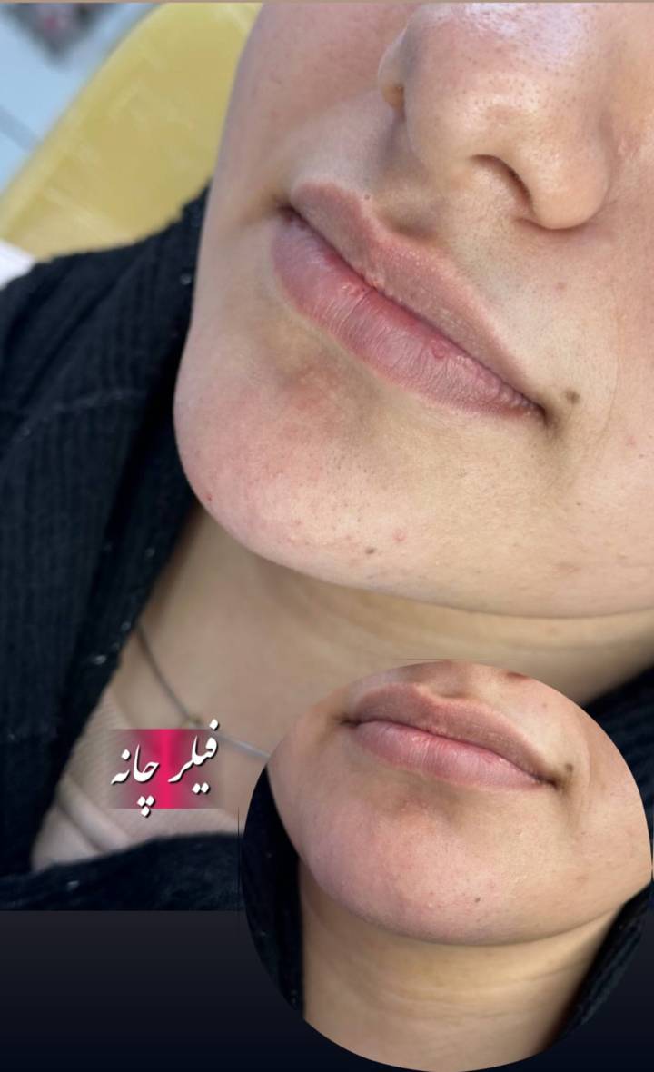 نمونه جوانسازی و فیلر خط خنده در بهترین کلینیک زیبایی در فولادشهر