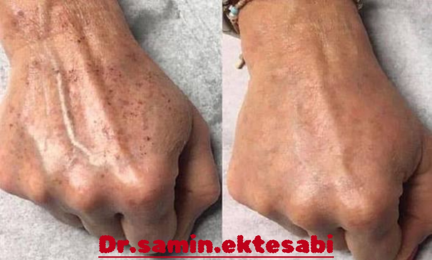 نمونه کار کانتورینگ فول فیس و فیلر بادی شیراز