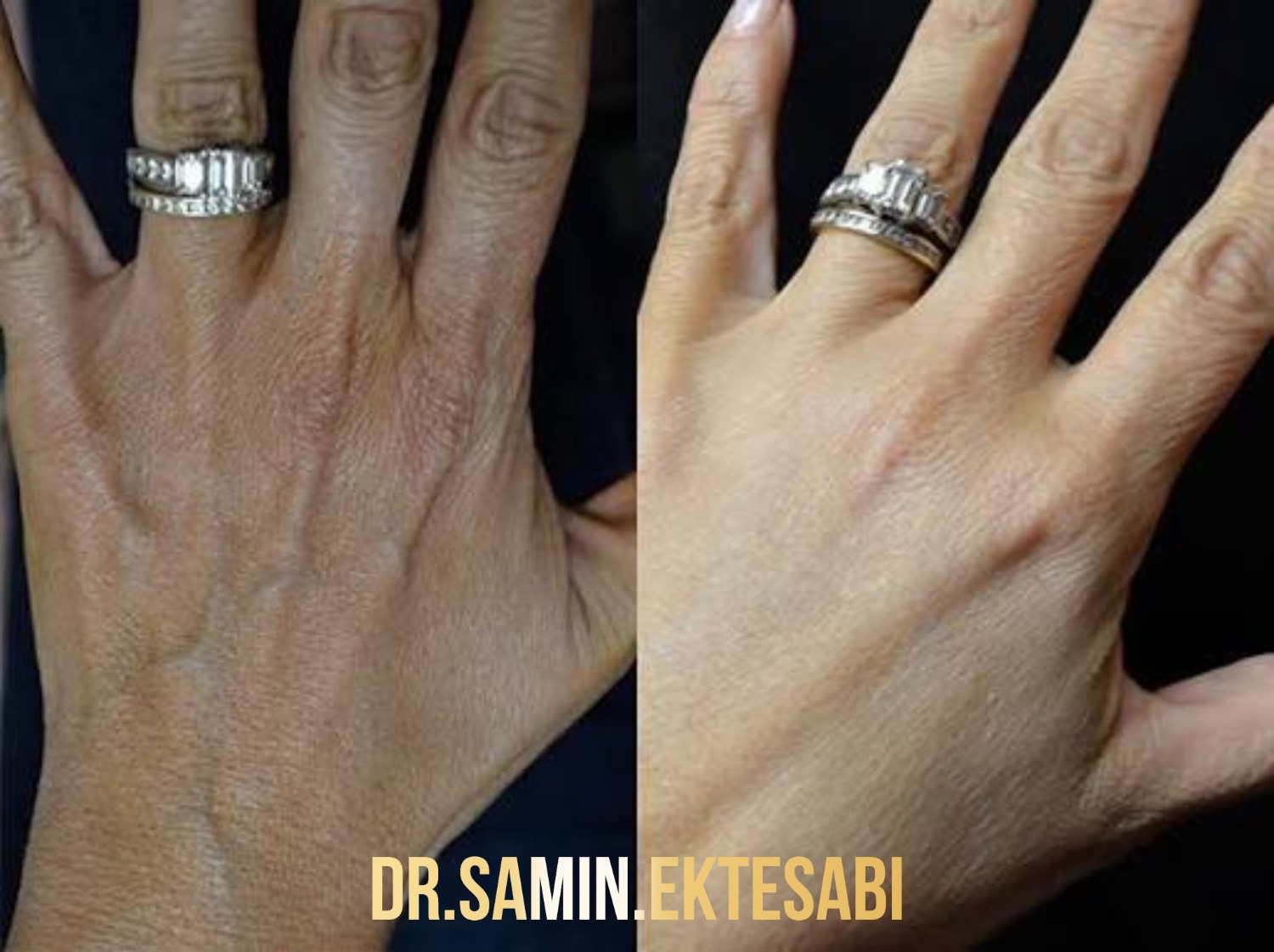 نمونه کار کانتورینگ فول فیس و فیلر بادی شیراز