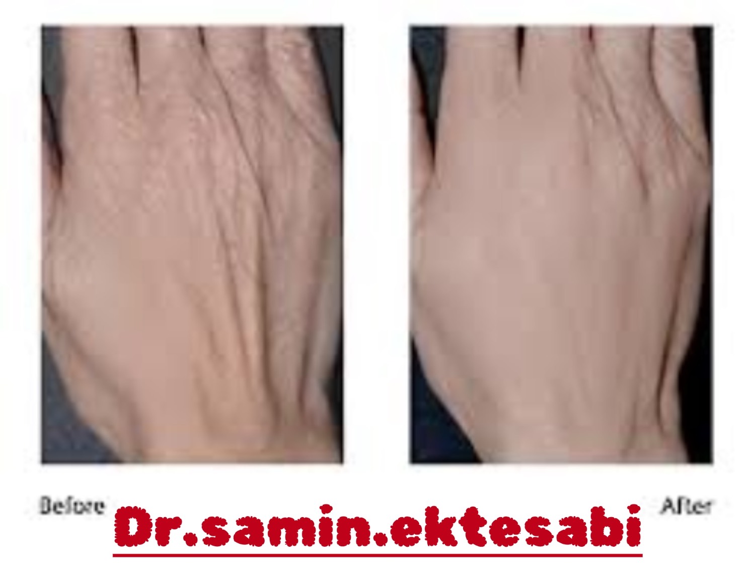 نمونه کار کانتورینگ فول فیس و فیلر بادی شیراز