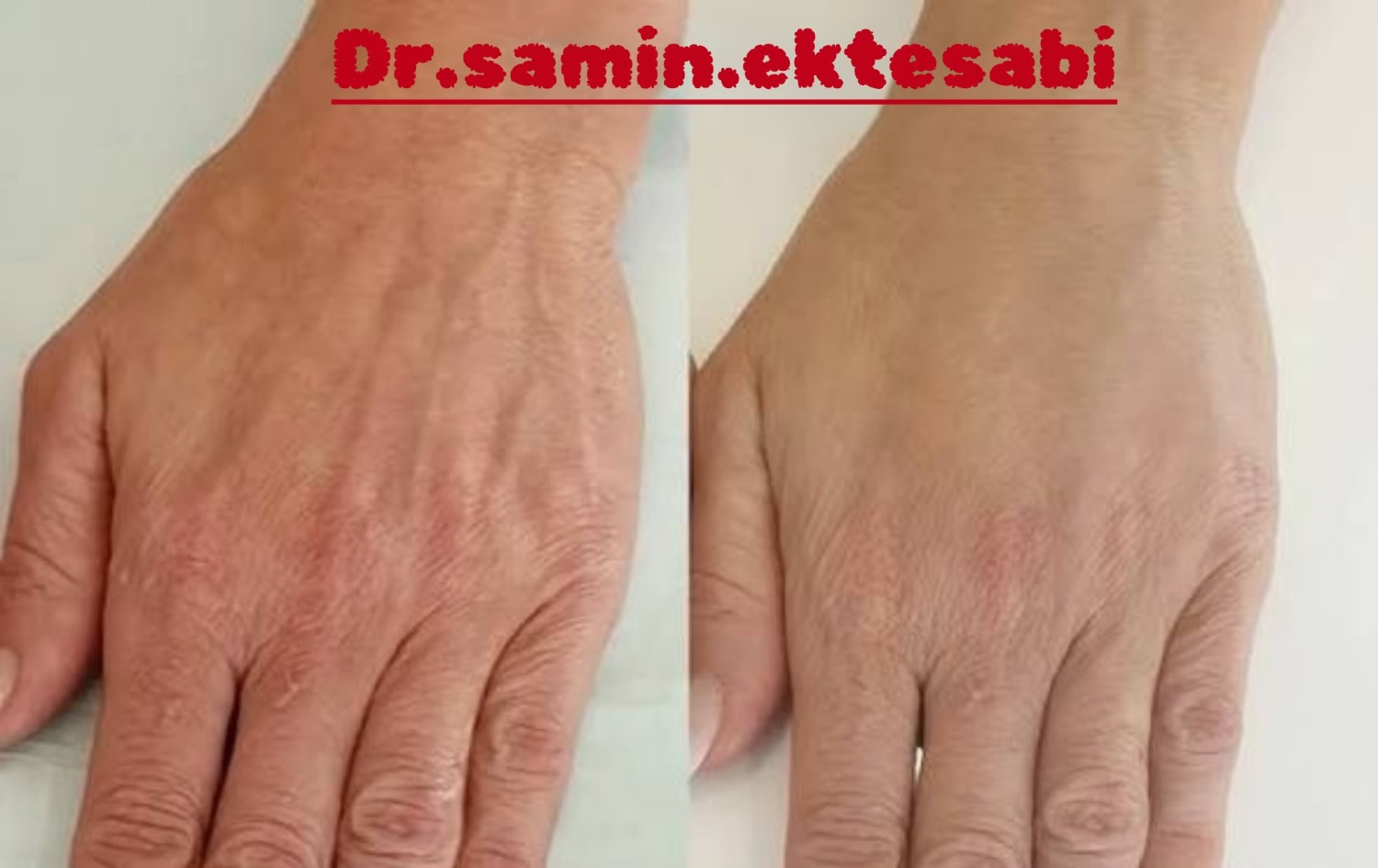 نمونه کار کانتورینگ فول فیس و فیلر بادی شیراز
