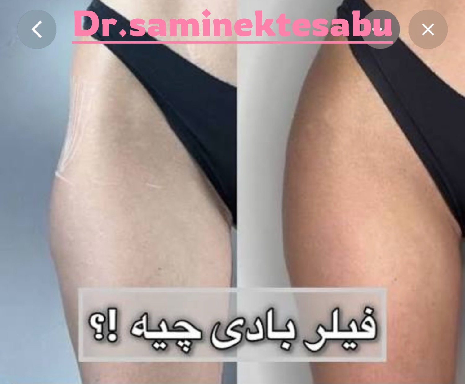 نمونه کار تزریق فیلر بادی برای فرم‌دهی و زیبایی اندام