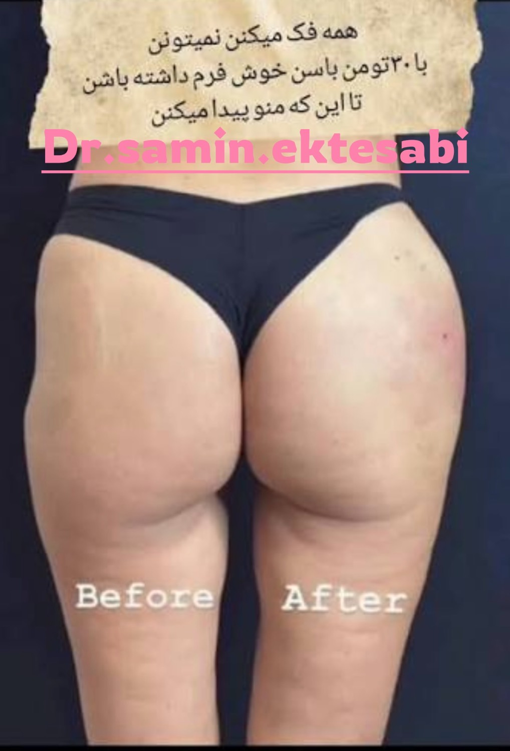 نمونه کار فیلر بادی در مرکز خدمات زیبایی و فرم‌دهی بدن شیراز