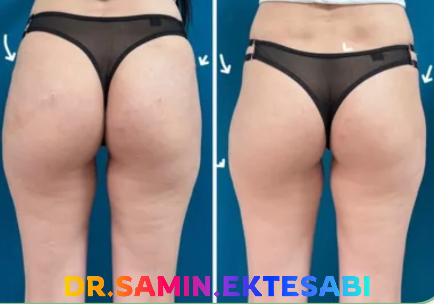 نمونه کار فیلر بادی برای فرم‌دهی و ایجاد تناسب بیشتر در اندام