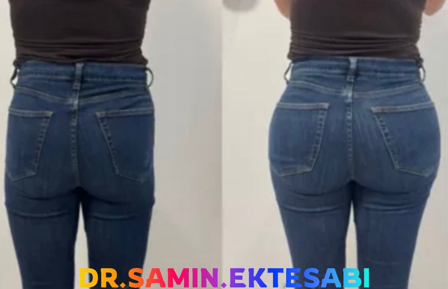 نمونه کار فیلر بادی شیراز با نتیجه طبیعی و فرم متناسب‌تر