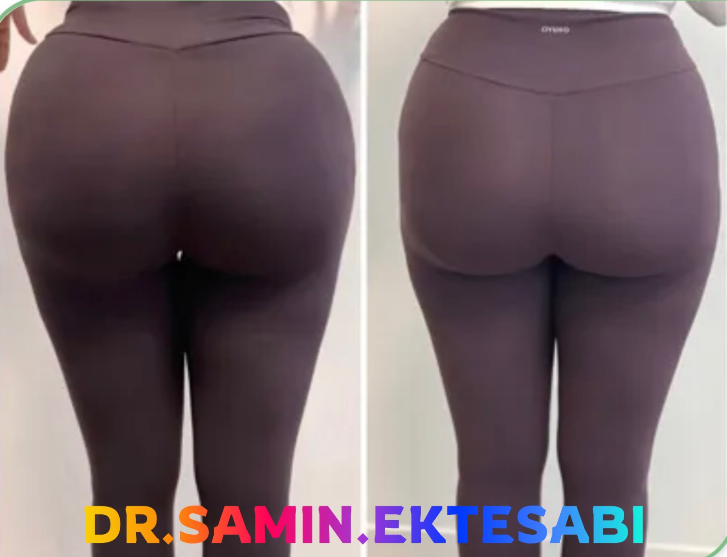 نمونه کار فیلر بادی و فرم‌دهی اندام در مجموعه زیبایی شیراز