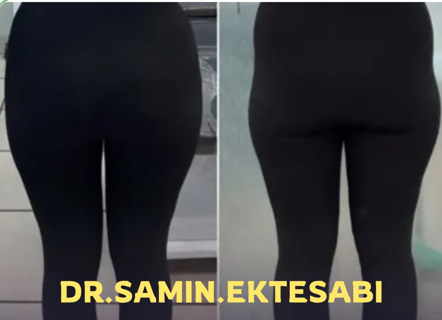 نمونه کار فیلر بادی برای اصلاح فرم و افزایش زیبایی ظاهری بدن