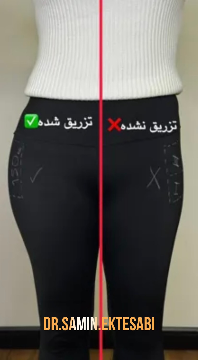 نمونه کار فیلر بادی شیراز برای ایجاد فرم زیباتر و متناسب‌تر