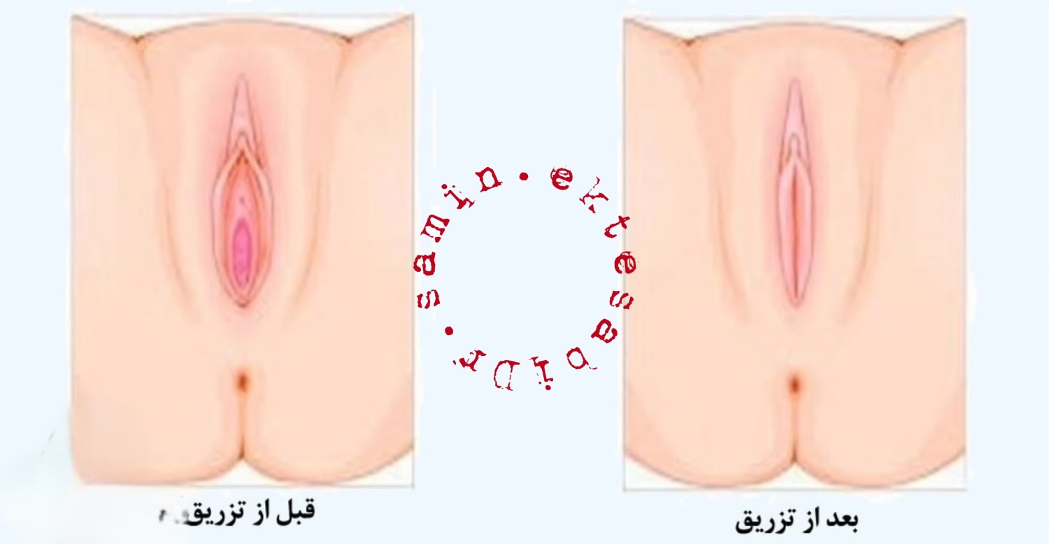 نمونه کار فیلر بادی شیراز