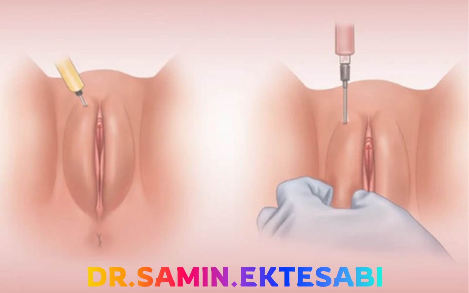 نمونه کار فیلر بادی شیراز