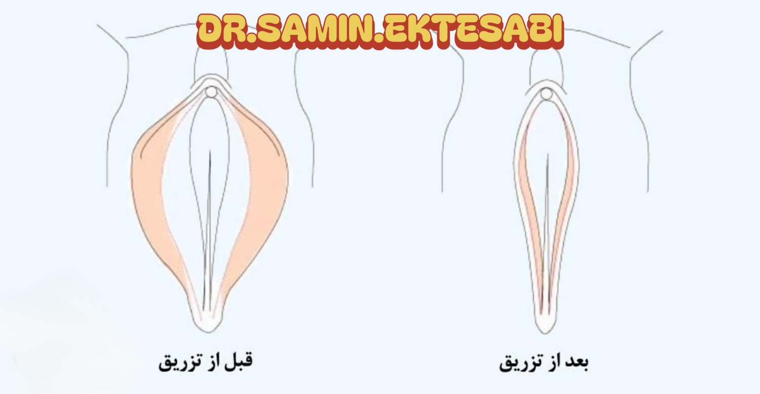 نمونه کار فیلر بادی شیراز