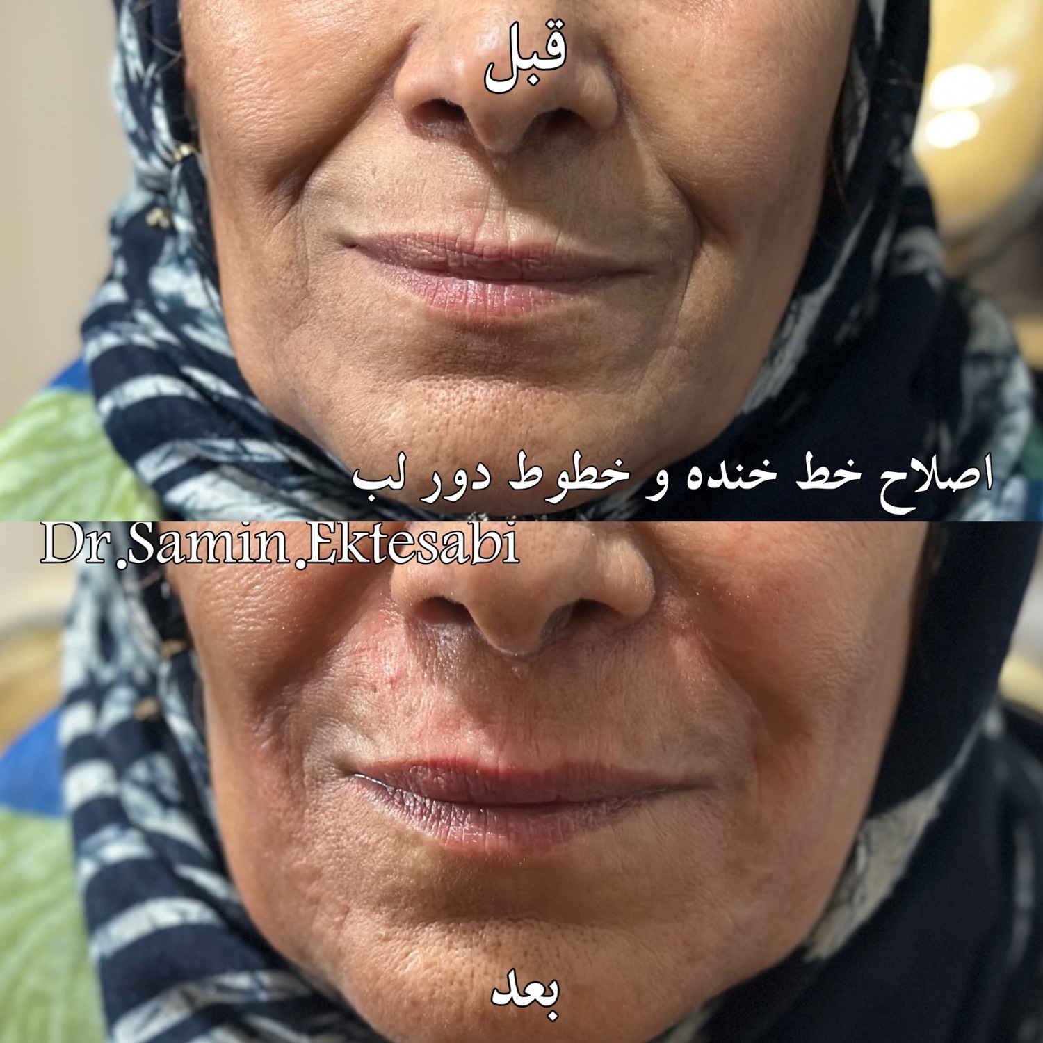 نمونه کار فیلر بادی شیراز