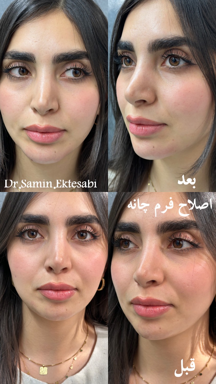 نمونه کار فیلر بادی شیراز