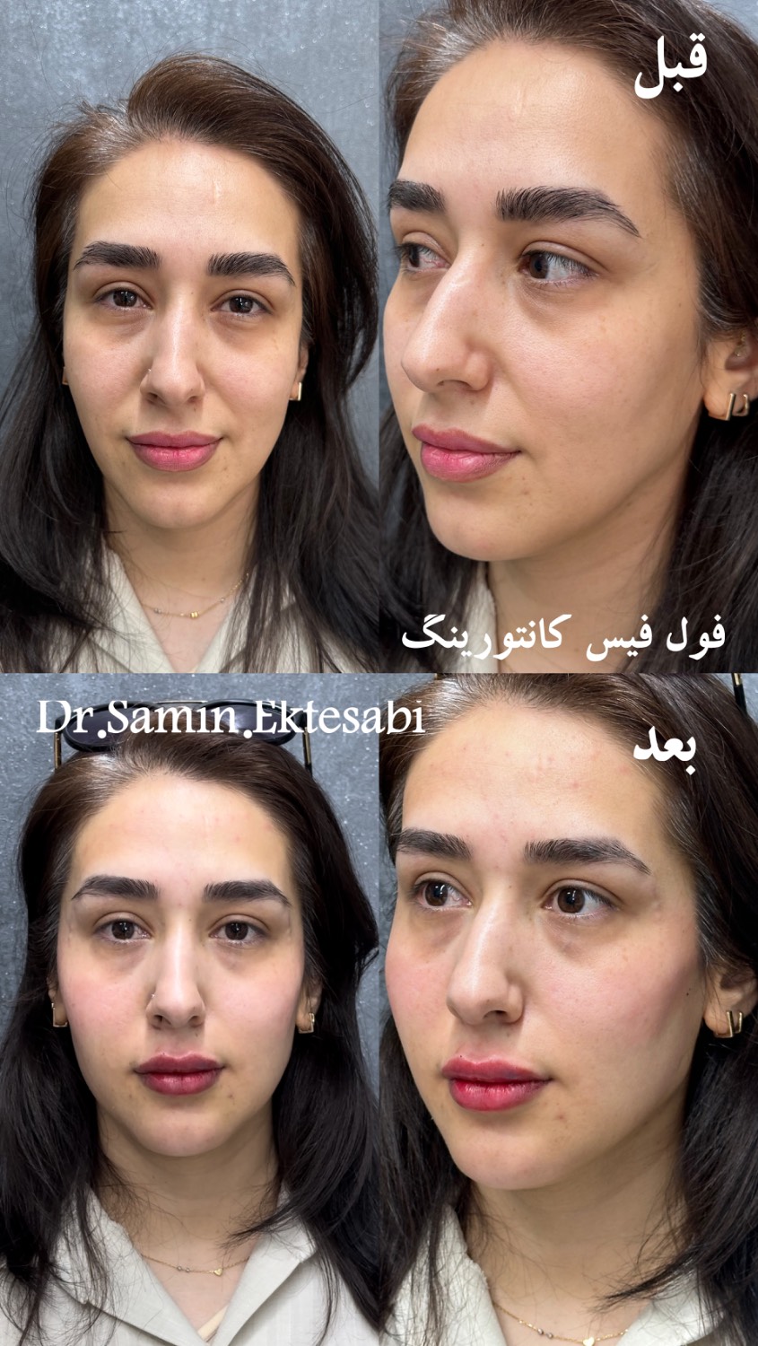 نمونه کار فیلر بادی شیراز