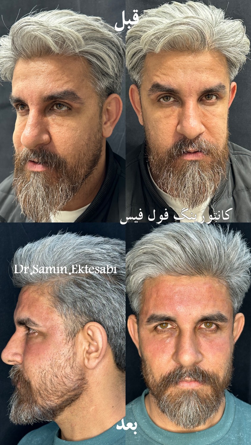 نمونه کار فیلر بادی شیراز