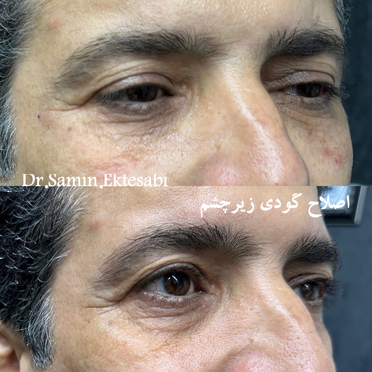 نمونه کار فیلر بادی شیراز