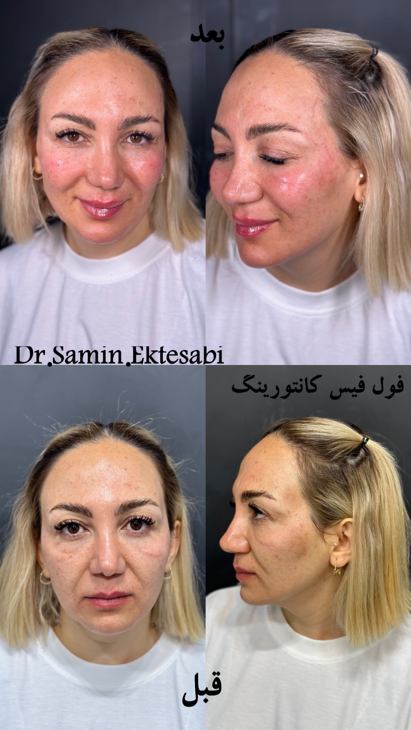نمونه کار فیلر بادی شیراز