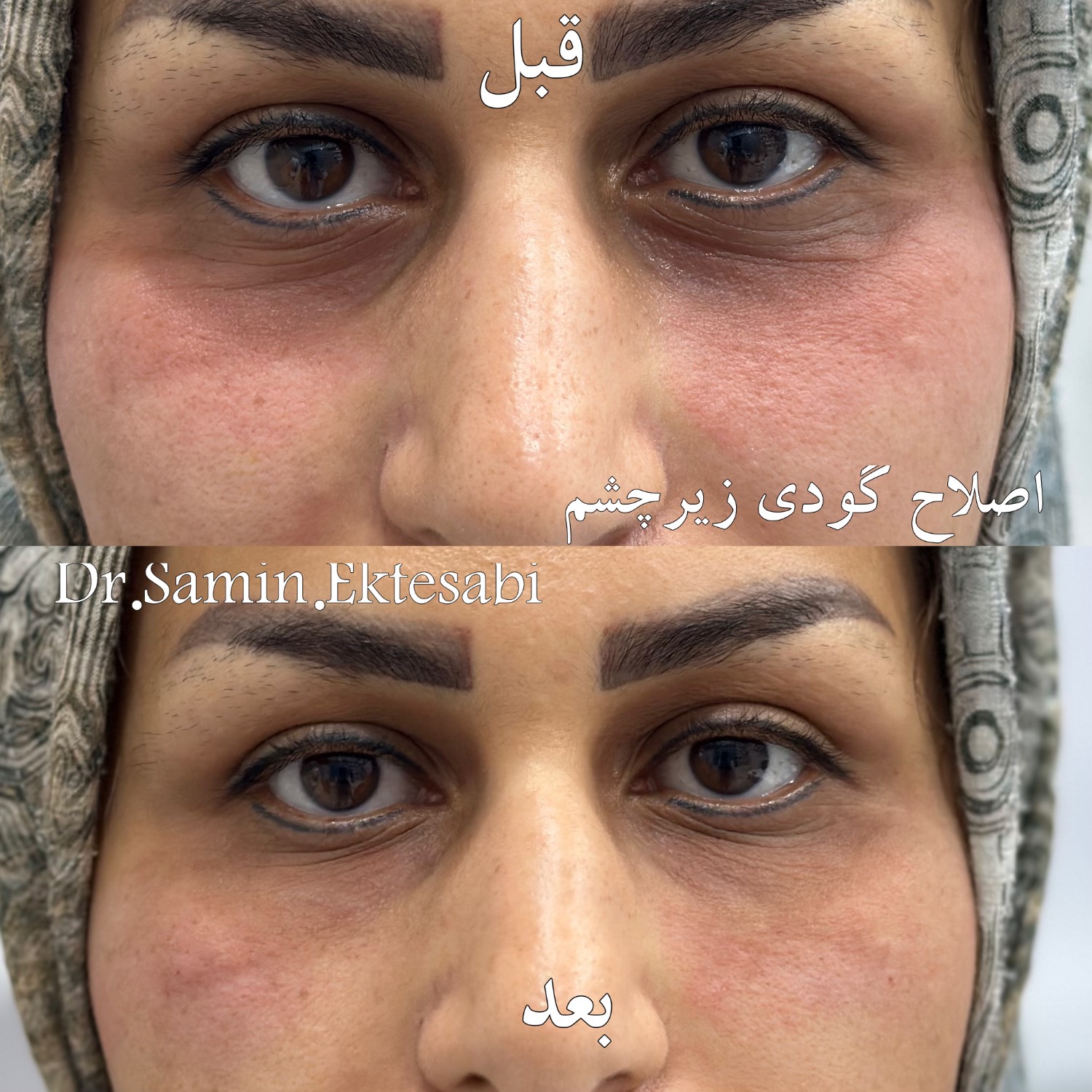 نمونه کار فیلر بادی شیراز