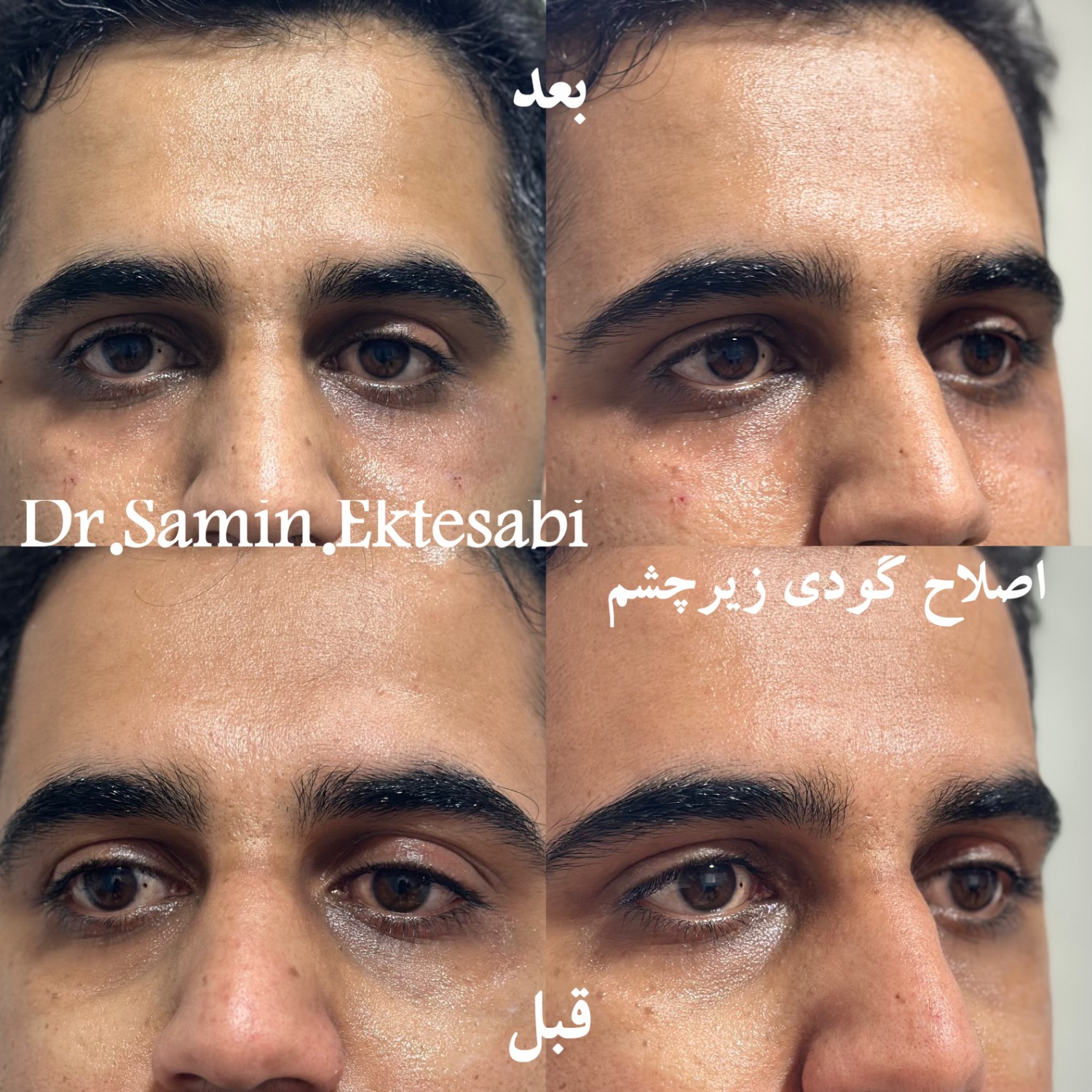نمونه کار فیلر بادی شیراز
