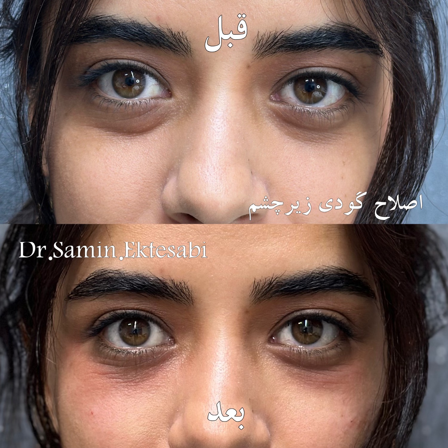 نمونه کار فیلر بادی شیراز