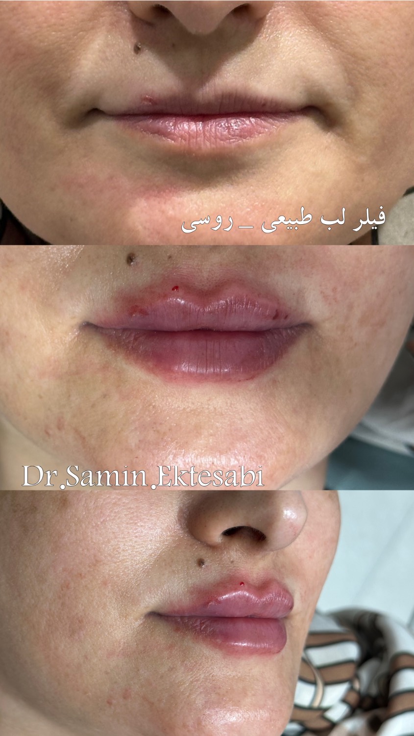 نمونه کار فیلر بادی شیراز