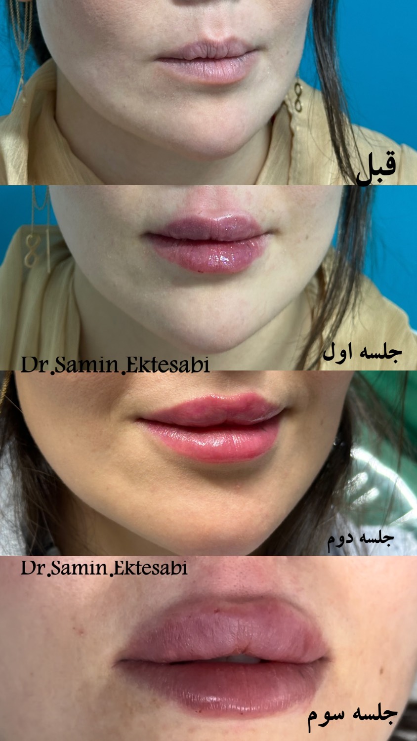 نمونه کار فیلر بادی شیراز