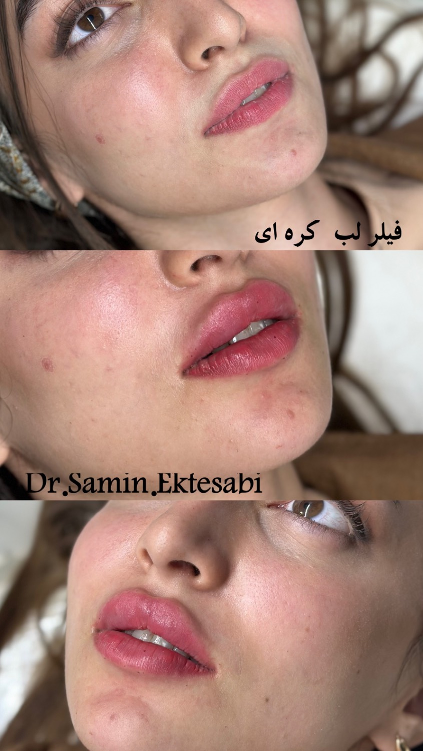 نمونه کار فیلر بادی شیراز