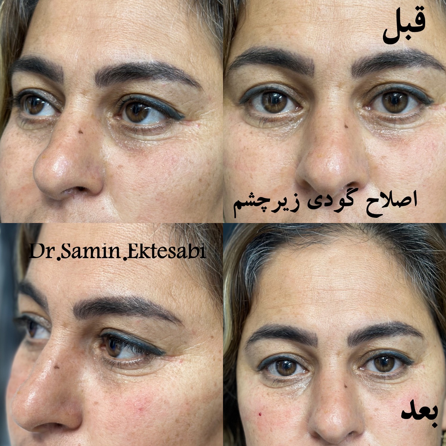 نمونه کار فیلر بادی شیراز