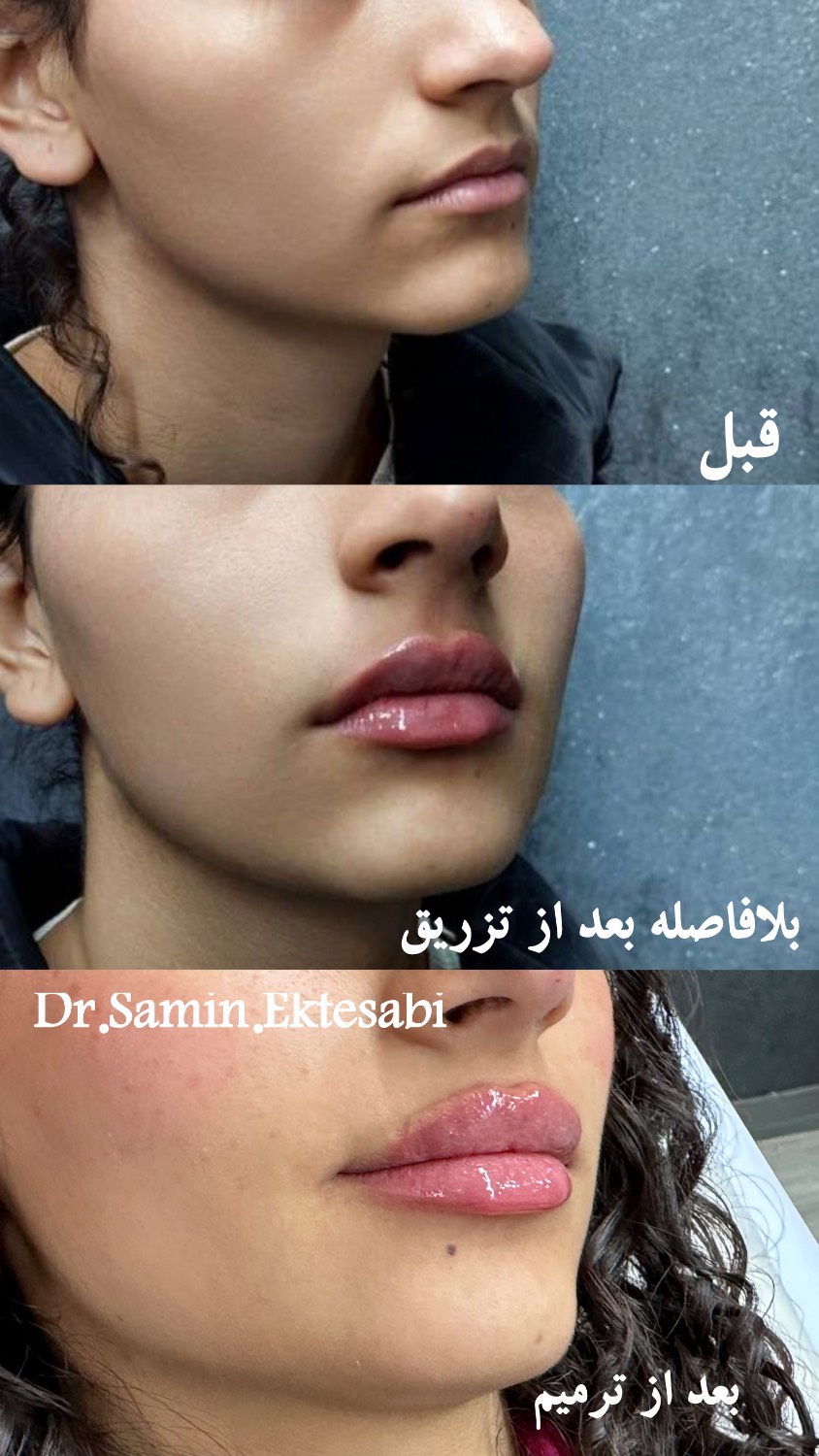 نمونه کار فیلر بادی شیراز