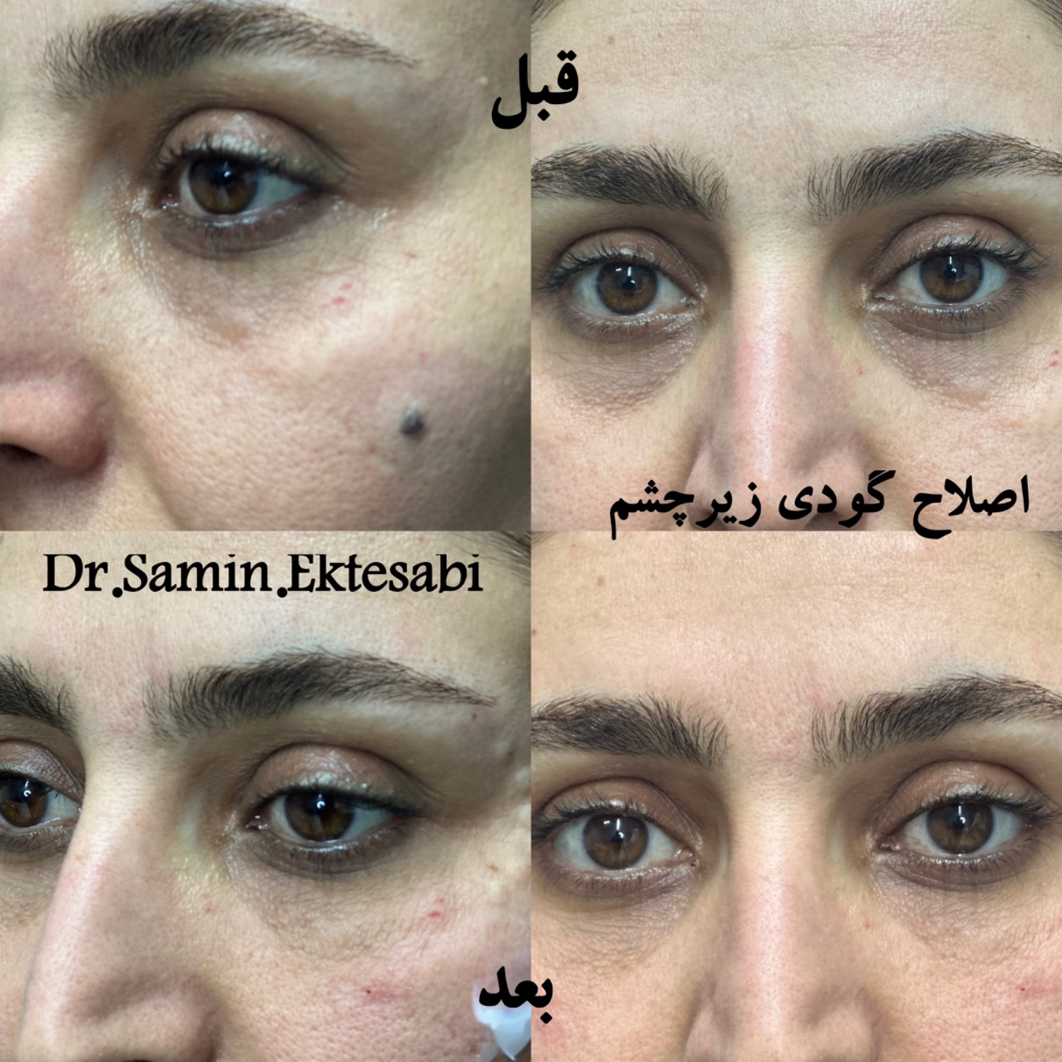 نمونه کار فیلر بادی شیراز