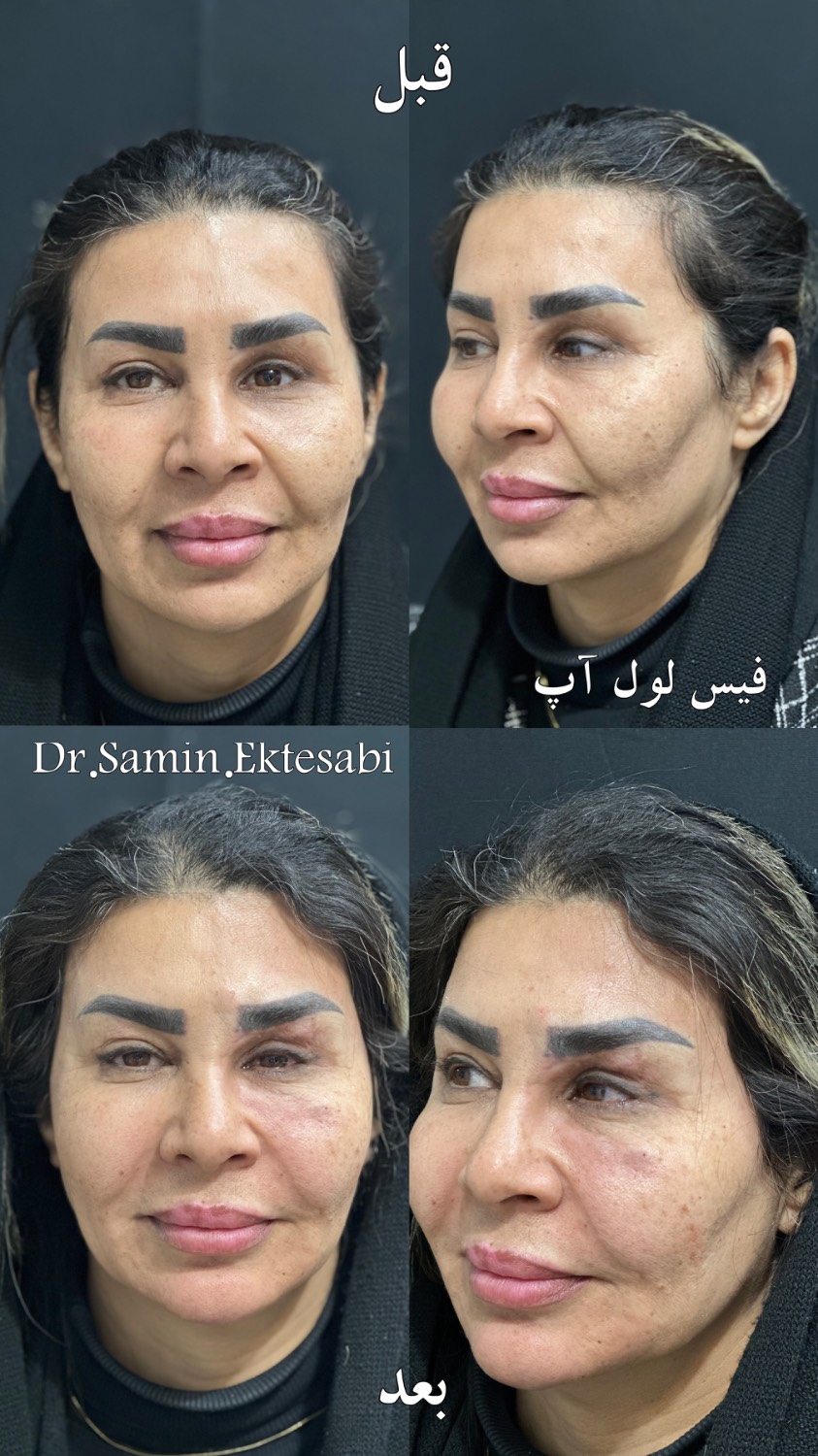 نمونه کار فیلر بادی شیراز