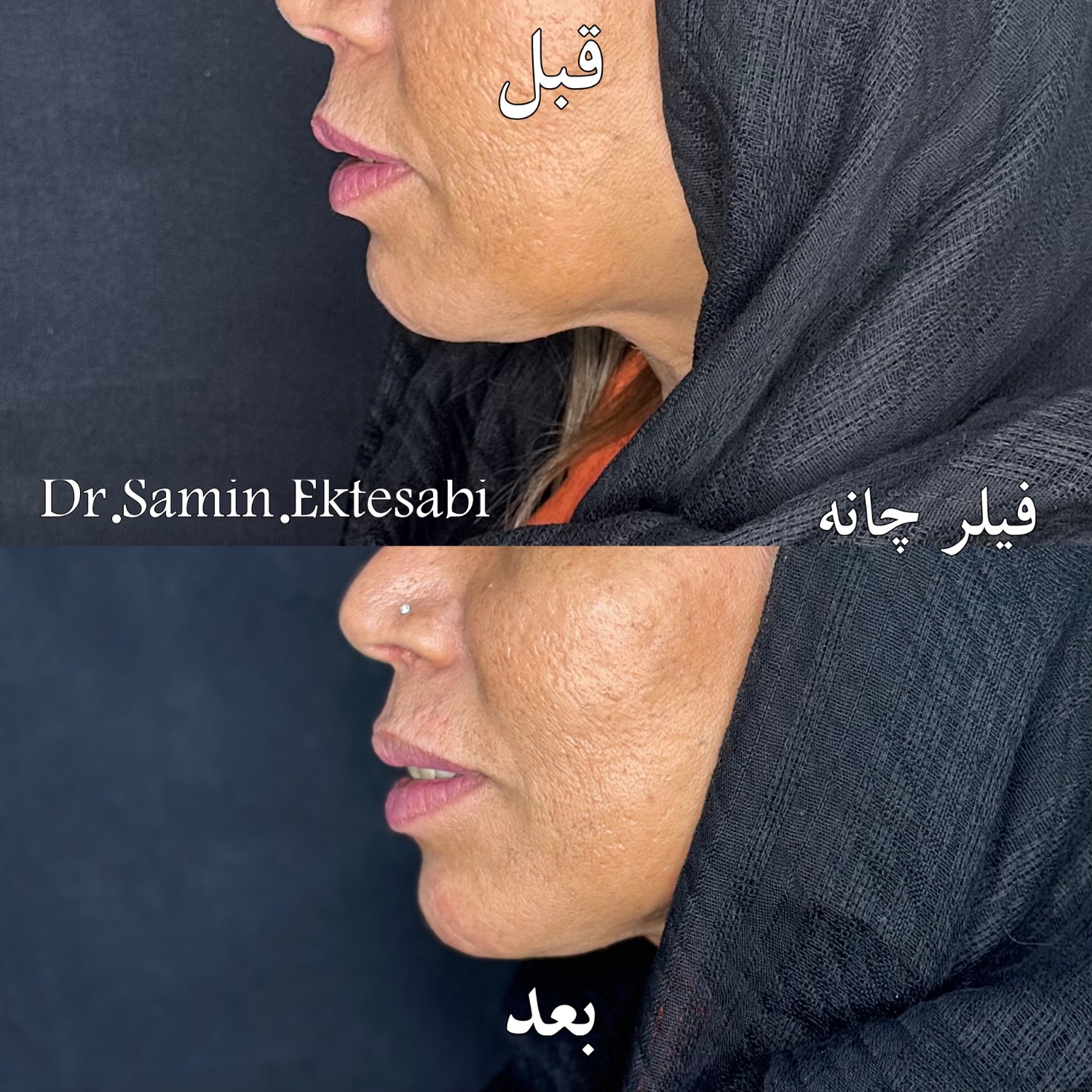 نمونه کار فیلر بادی شیراز