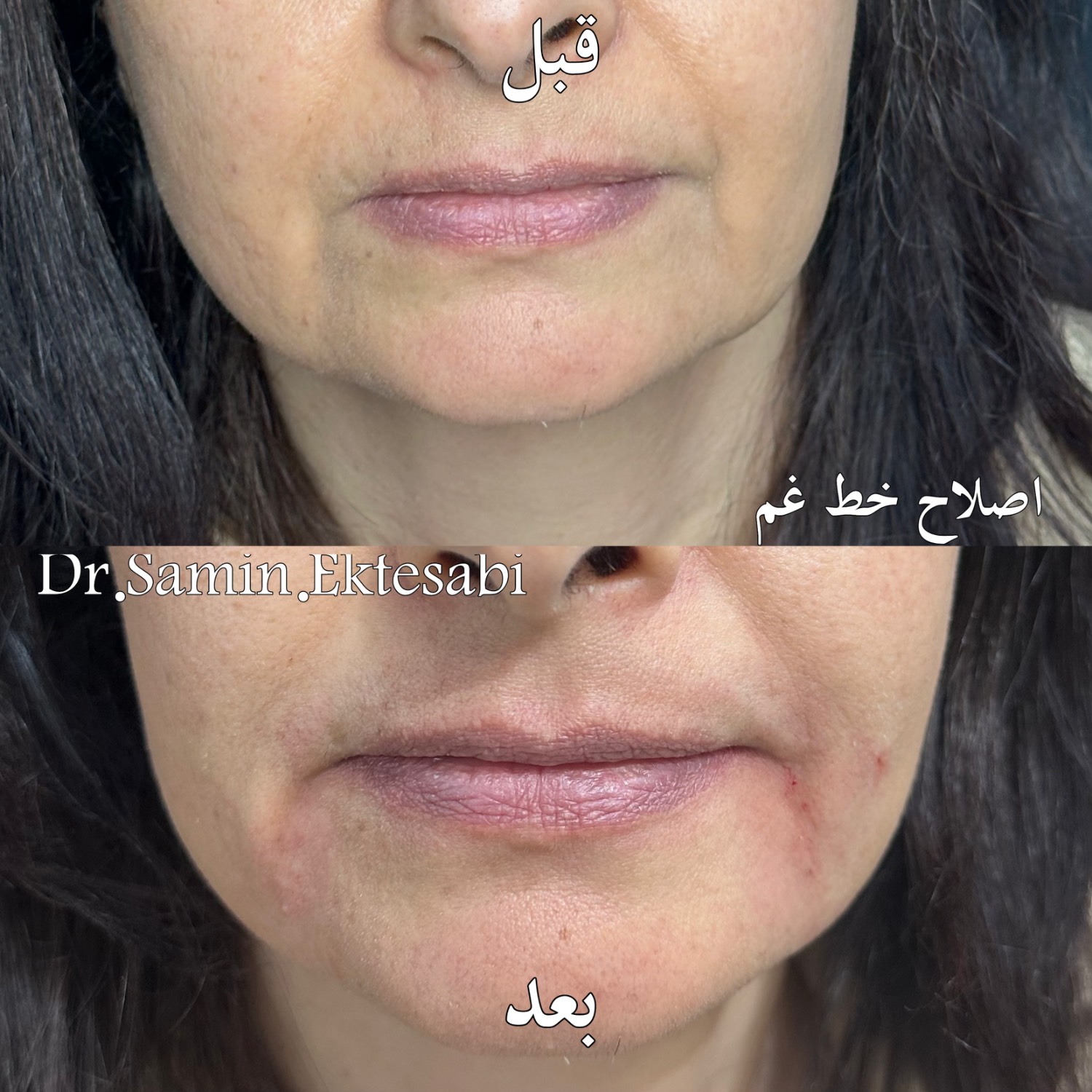 نمونه کار فیلر بادی شیراز