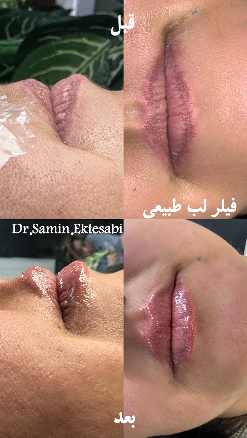 نمونه کار فیلر بادی شیراز