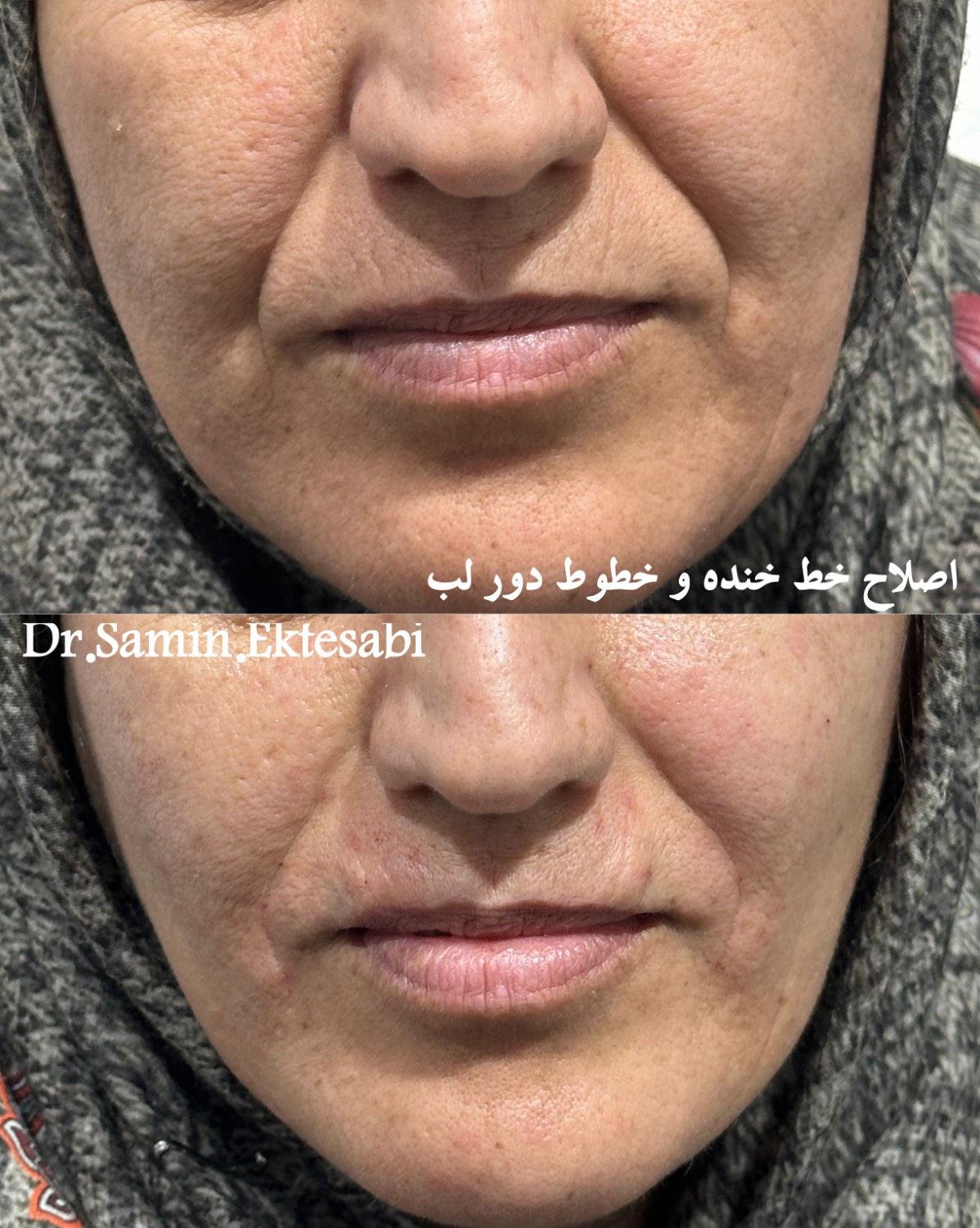 نمونه کار فیلر بادی شیراز