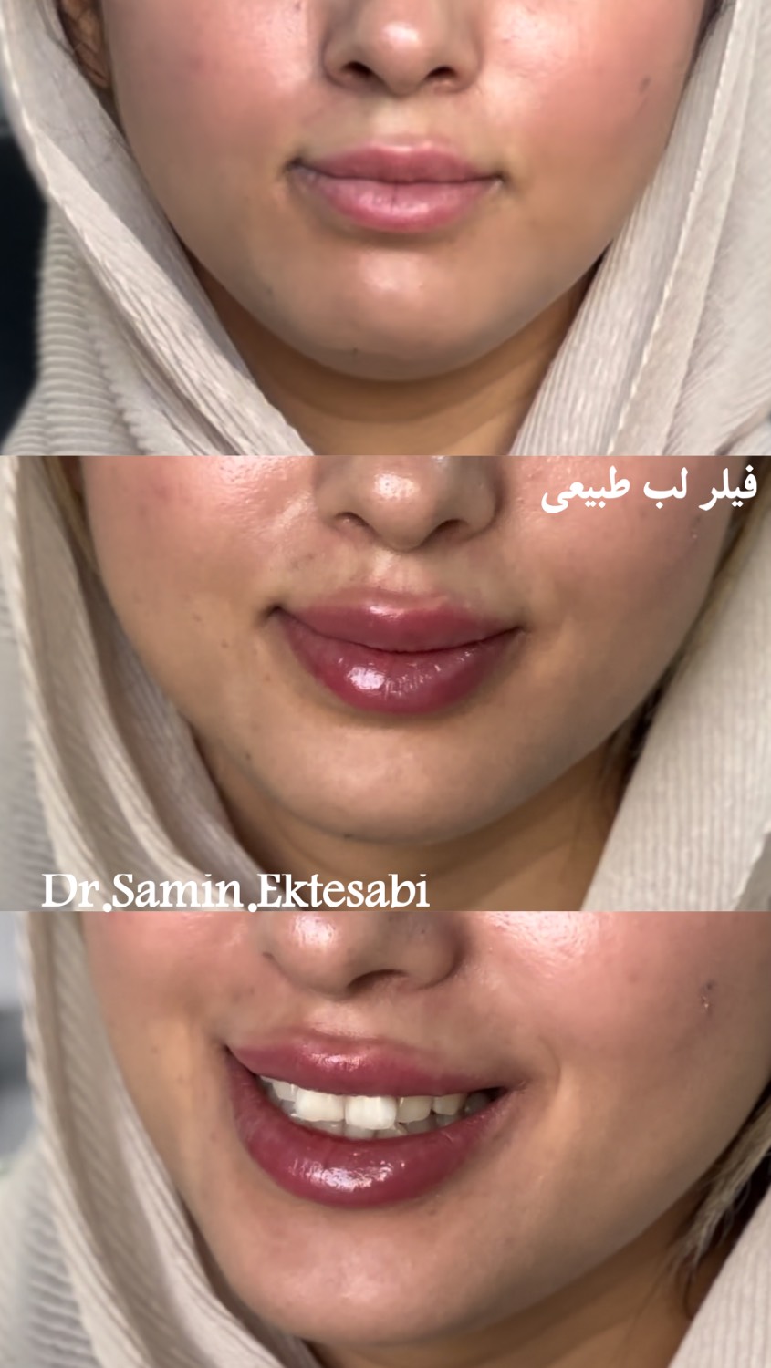 نمونه کار فیلر بادی شیراز