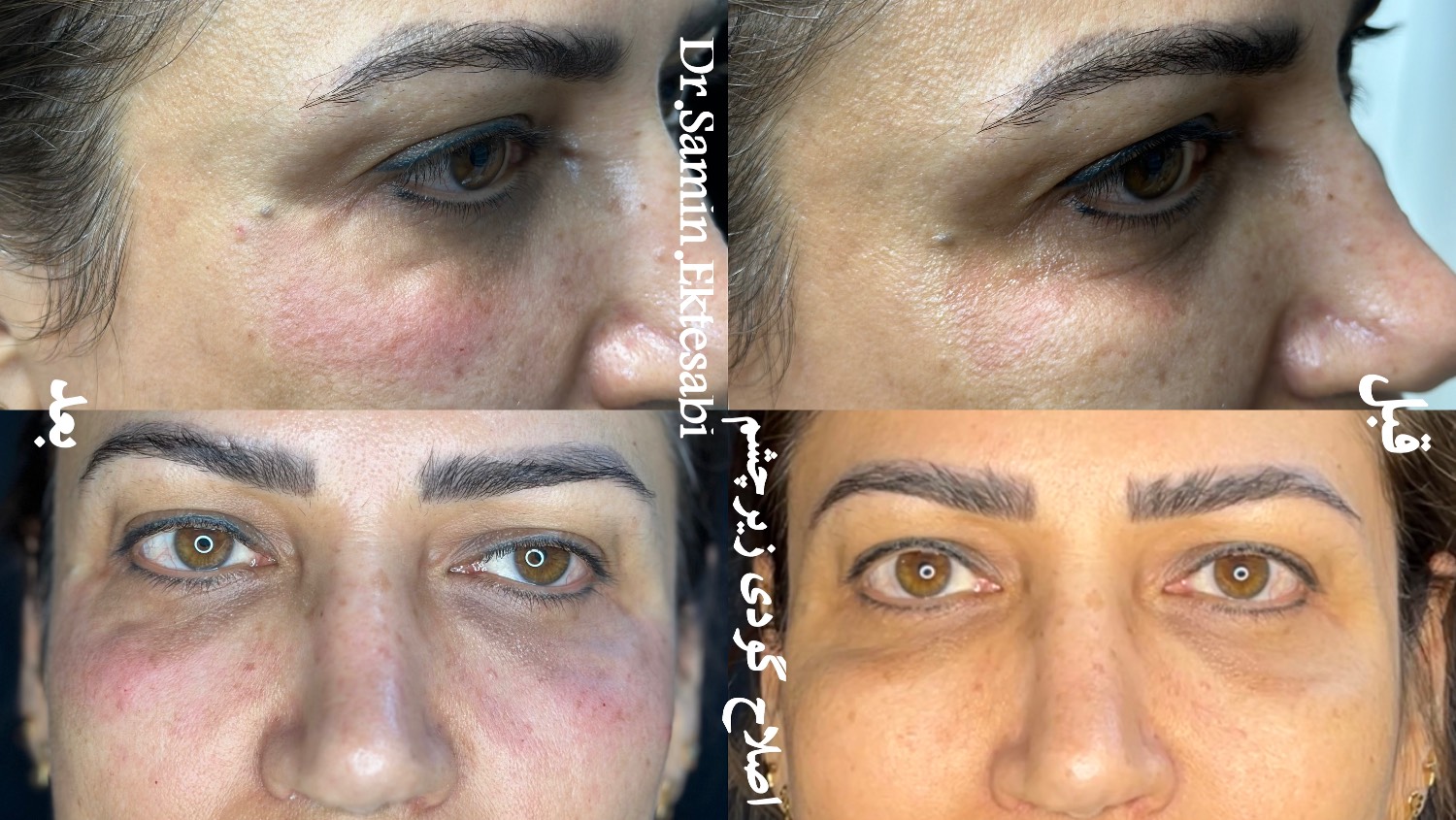 نمونه کار فیلر بادی شیراز