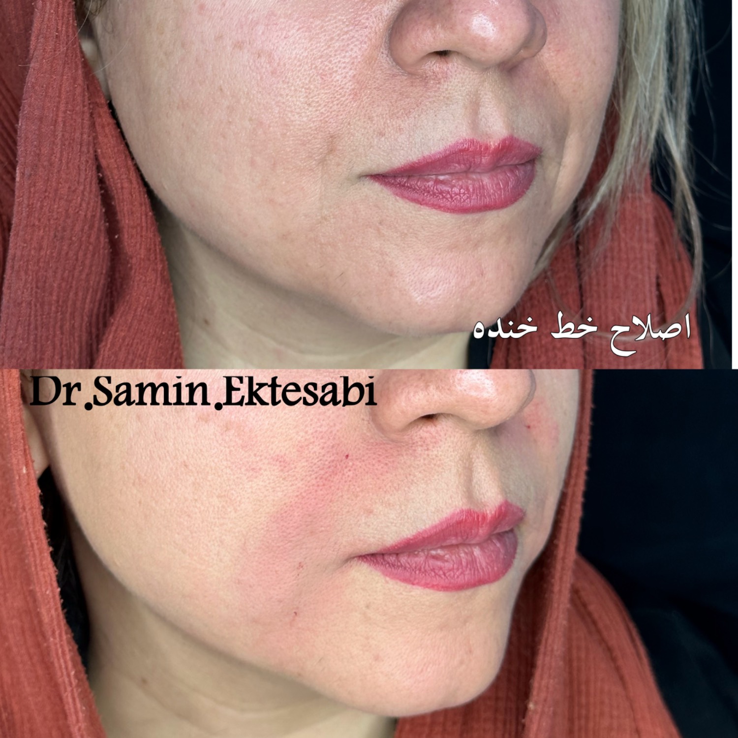 نمونه کار فیلر بادی شیراز