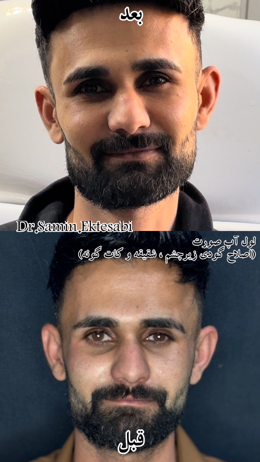 نمونه کار فیلر بادی شیراز