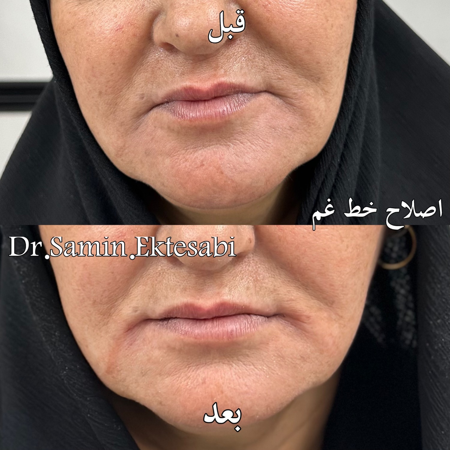 نمونه کار فیلر بادی شیراز