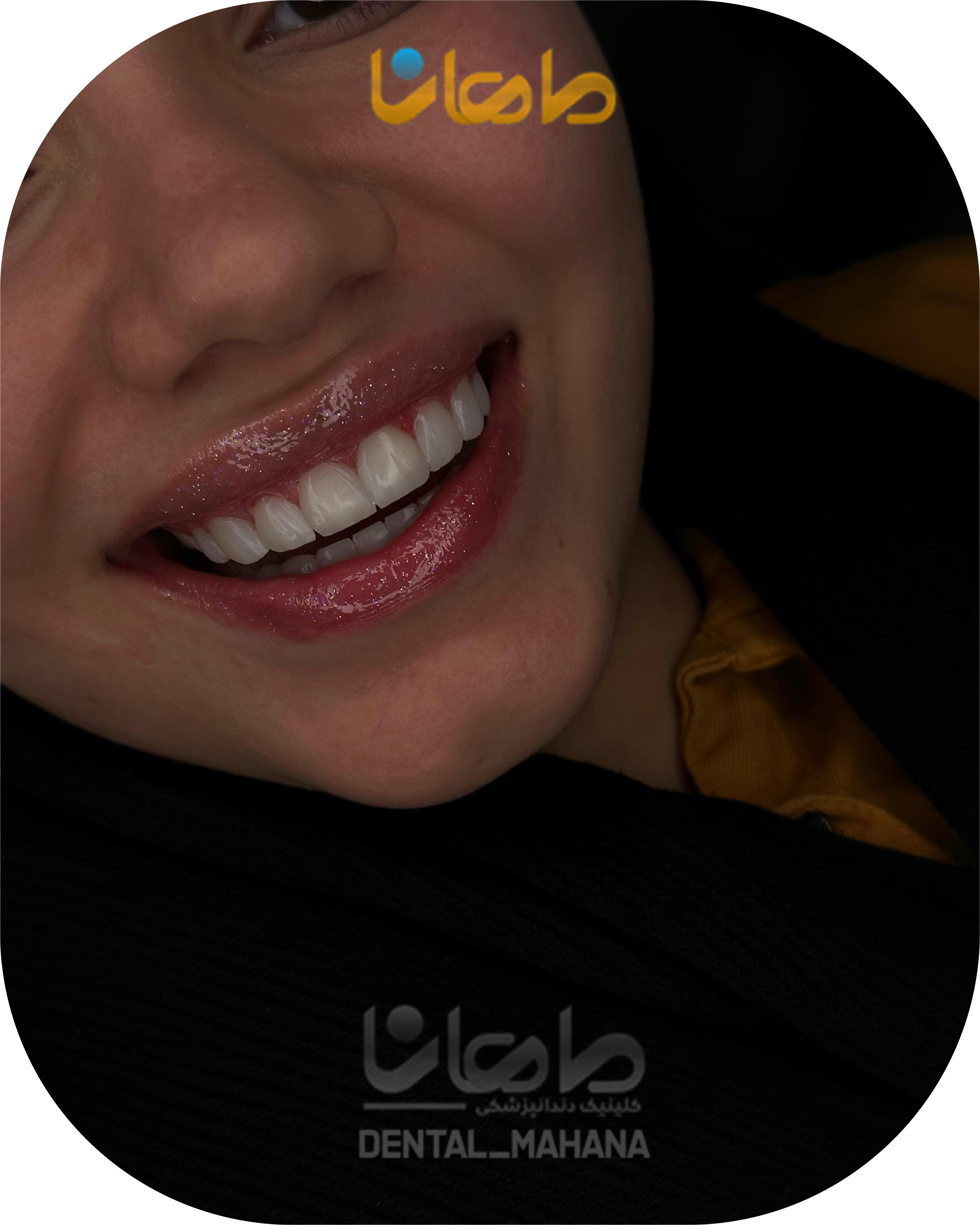 لمینت اقساطی