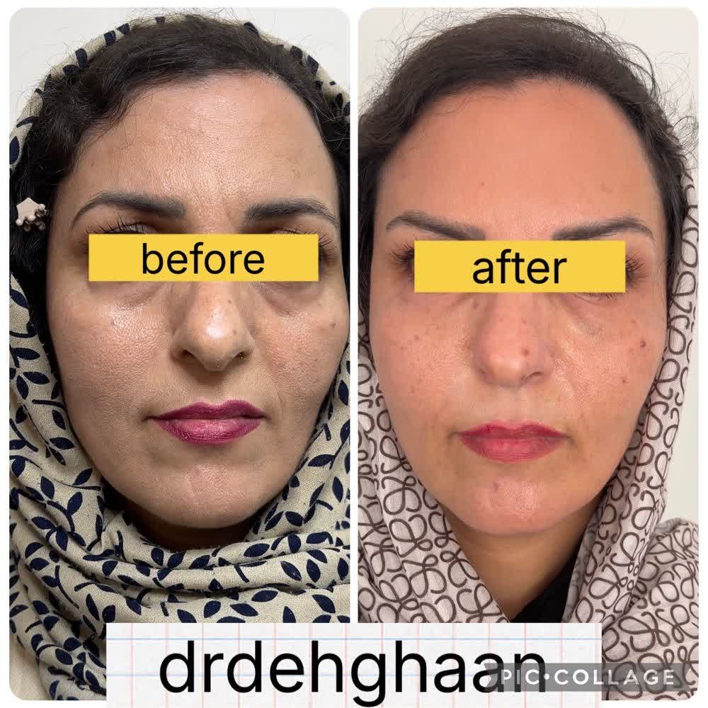 جوانسازی با بوتاکس