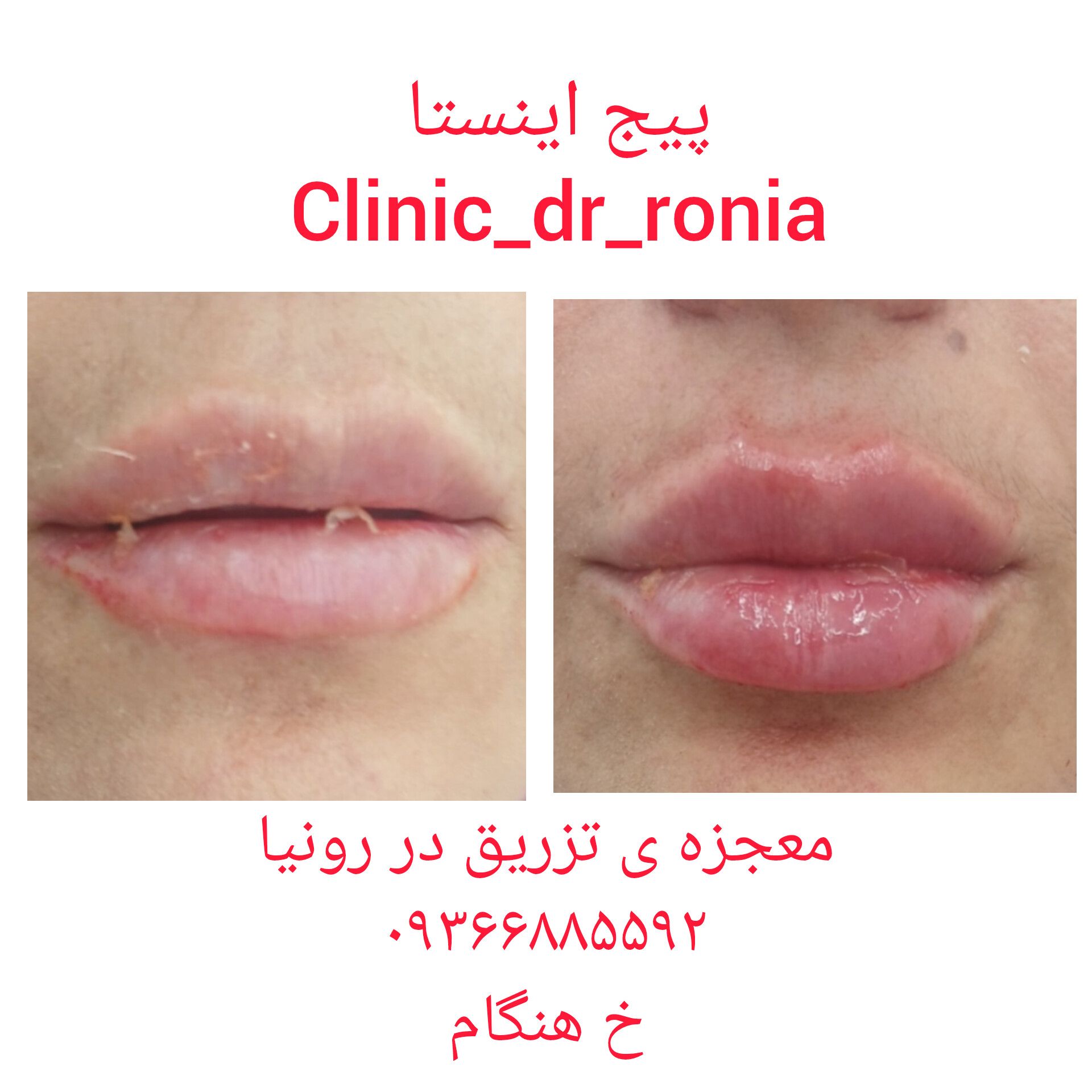 تزريق ژل و بوتاکس در نارمک&nbsp;