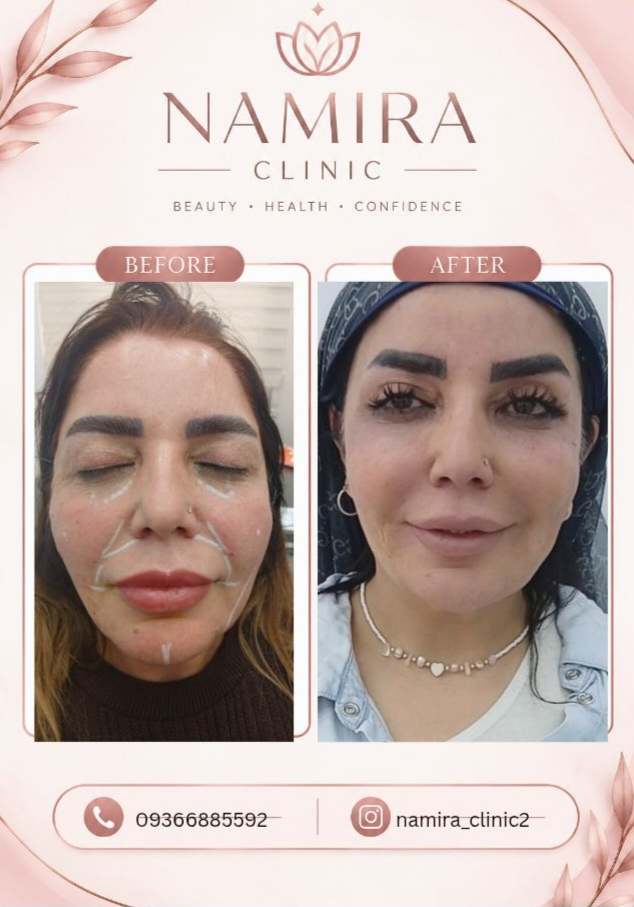 تزريق ژل و بوتاکس در نارمک