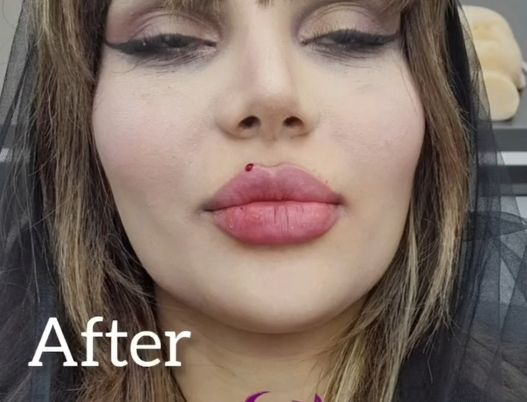 تزريق ژل و بوتاکس در نارمک
